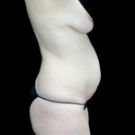 Breast Augmentation (Implants) Before & After Patient #23136