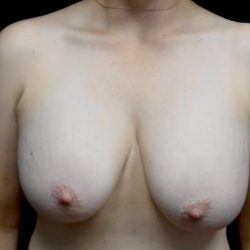 Breast Lift Before & After Patient #23129
