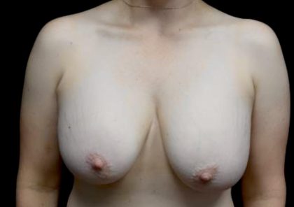 Breast Lift Before & After Patient #23129