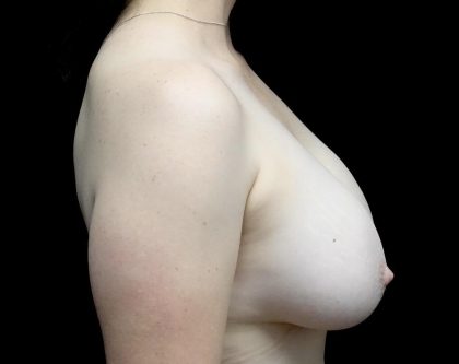 Breast Lift Before & After Patient #23129