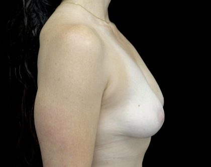 Breast Lift Before & After Patient #23129