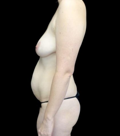 Breast Augmentation (Implants) Before & After Patient #23136