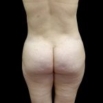 Buttock Augmentation Before & After Patient #23150