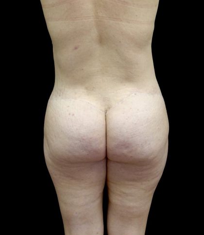 Buttock Augmentation Before & After Patient #23150