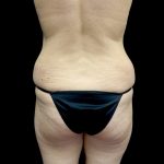 Buttock Augmentation Before & After Patient #23150
