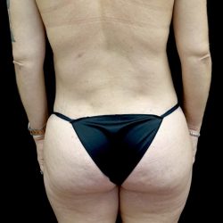 Buttock Augmentation Before & After Patient #23150