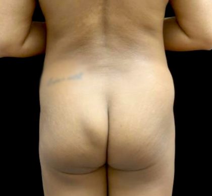 Buttock Augmentation Before & After Patient #23230