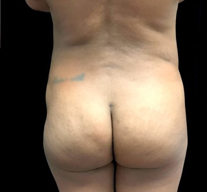 Buttock Augmentation Before & After Patient #23230