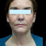 Facelift Before & After Patient #23209