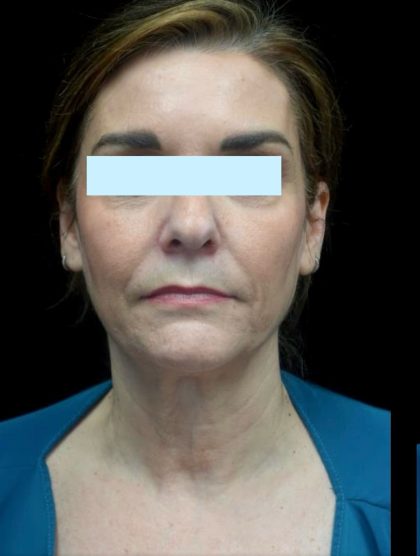 Facelift Before & After Patient #23209