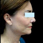 Facelift Before & After Patient #23209