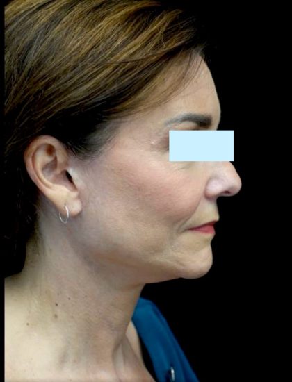 Facelift Before & After Patient #23209