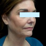 Facelift Before & After Patient #23209