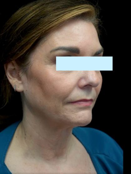 Facelift Before & After Patient #23209