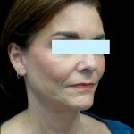 Facelift Before & After Patient #23209