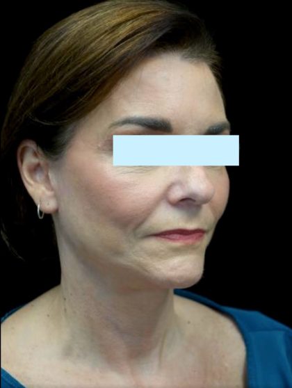 Facelift Before & After Patient #23209