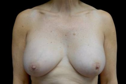 Breast Implant Removal (Explant Surgery) Before & After Patient #23223