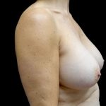 Breast Implant Removal (Explant Surgery) Before & After Patient #23223