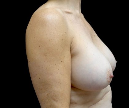 Breast Implant Removal (Explant Surgery) Before & After Patient #23223