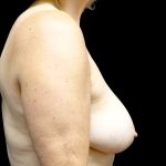 Breast Implant Removal (Explant Surgery) Before & After Patient #23223