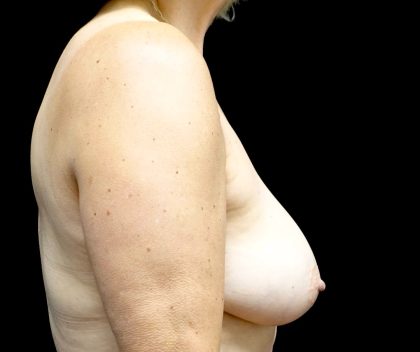 Breast Implant Removal (Explant Surgery) Before & After Patient #23223