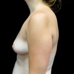 Breast Augmentation (Fat Transfer) Before & After Patient #23275