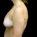 Breast Augmentation (Fat Transfer) Before & After Patient #23275