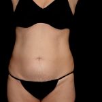 Tummy Tuck Before & After Patient #23306