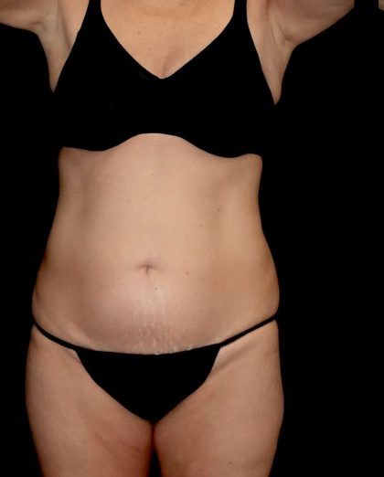 Tummy Tuck Before & After Patient #23306