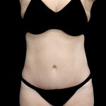 Tummy Tuck Before & After Patient #23306