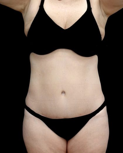 Tummy Tuck Before & After Patient #23306