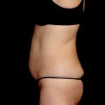 Tummy Tuck Before & After Patient #23306