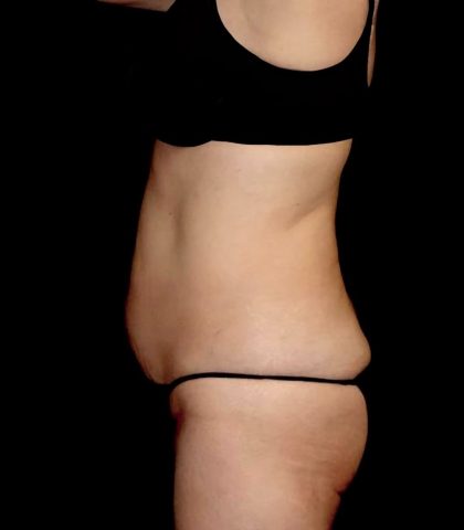 Tummy Tuck Before & After Patient #23306