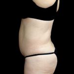 Tummy Tuck Before & After Patient #23306