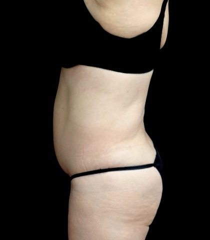 Tummy Tuck Before & After Patient #23306