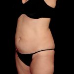 Tummy Tuck Before & After Patient #23306