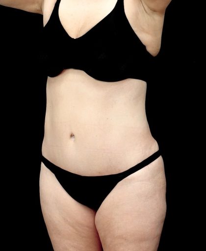 Tummy Tuck Before & After Patient #23306