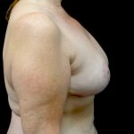 Breast Lift Before & After Patient #23282