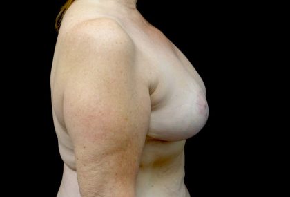 Breast Lift Before & After Patient #23282