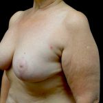 Breast Lift Before & After Patient #23282