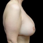 Breast Lift with Implants Before & After Patient #23289