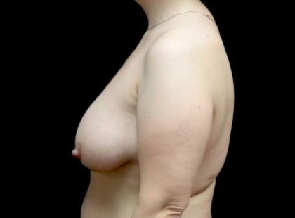 Breast Lift with Implants Before & After Patient #23289