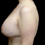 Breast Lift with Implants Before & After Patient #23289