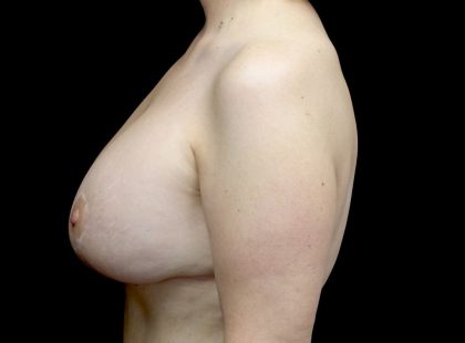 Breast Lift with Implants Before & After Patient #23289