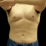 CoolSculpting Before & After Patient #23250