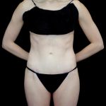 Tummy Tuck Before & After Patient #23425