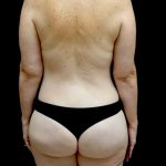 Lower Body Lift Before & After Patient #23453