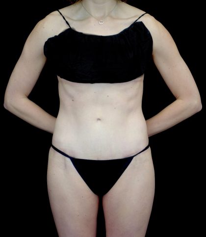 Tummy Tuck Before & After Patient #23425