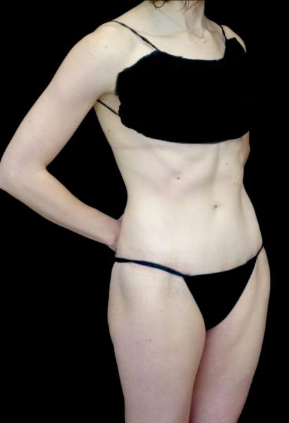 Tummy Tuck Before & After Patient #23425