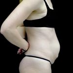 Tummy Tuck Before & After Patient #23425